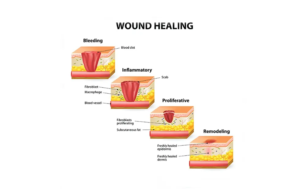 Diagram of the stages of wound healing